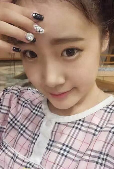 蘇州愛(ài)思特醫(yī)療美容醫(yī)院鄭曉明隆鼻案例效果分享