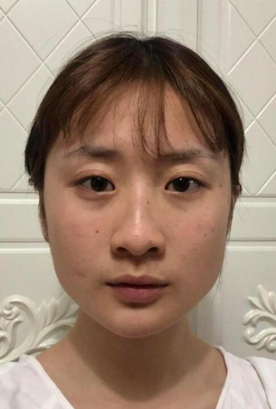 珠海陸達美容外科醫(yī)院做下頜角手術(shù)前的鼻子
