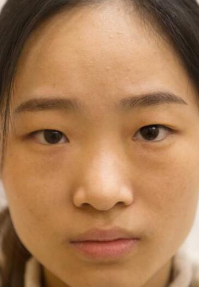 長(zhǎng)沙星雅醫(yī)療美容醫(yī)院萬(wàn)友望雙眼皮案例效果分享