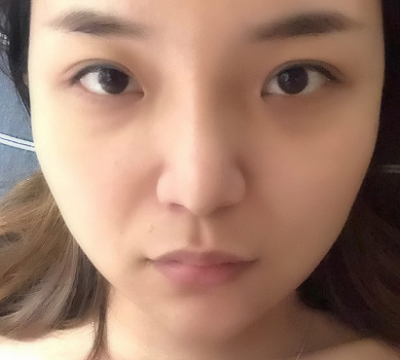 寧波尚美整形美容醫(yī)院做隆鼻手術(shù)后的一周 寧波尚美整形美容醫(yī)院做隆鼻手術(shù)后的一周