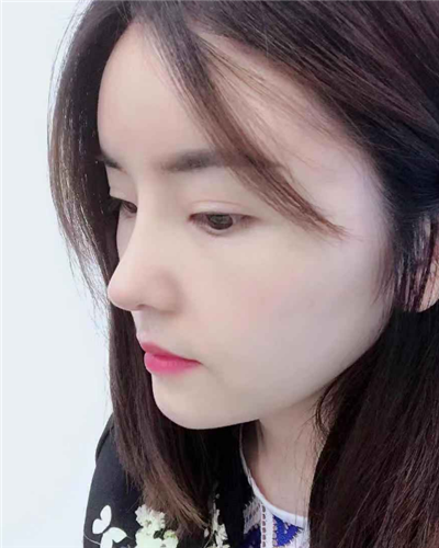 煙臺(tái)壹美整形美容醫(yī)院做隆鼻手術(shù)后整個(gè)鼻子的情形