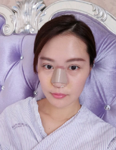  寧波尚美整形美容醫(yī)院做鼻綜合手術(shù)后的情況
