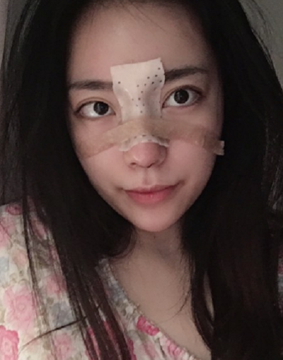 成都漢密爾頓美容醫(yī)院洪偉鼻修復案例效果分享