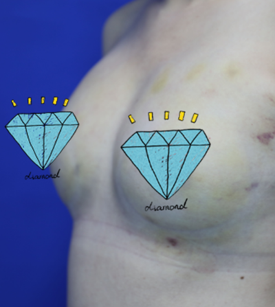 煙臺壹美整形美容醫(yī)院做隆胸手術后的側面情況 煙臺壹美整形美容醫(yī)院做隆胸手術后的側面情況