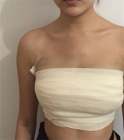  寧波珈禾整形?？漆t(yī)院雷中元隆胸案例效果分享