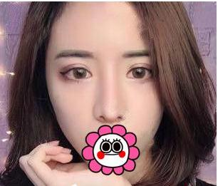 有“鼻王”之稱的楊群申做鼻子到底怎么樣？隆鼻前后圖片