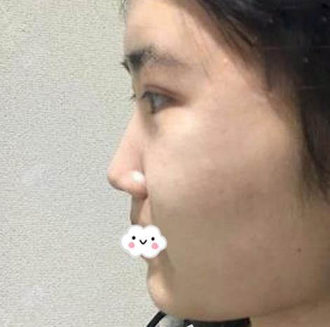 假體隆鼻假嗎？假體隆鼻三個(gè)月效果分享