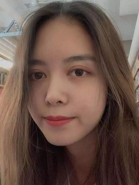 做雙眼皮案例，鄭州壹加壹王洛生全切雙眼皮案例圖片