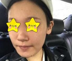 隆鼻真實案例，長沙亞韓鄭京湘隆鼻前后對比圖片