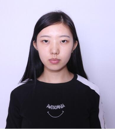 做雙眼皮案例，第四軍醫(yī)大學(xué)唐都醫(yī)院李望舟雙眼皮案例圖片