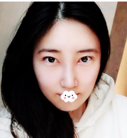 假體隆鼻假嗎？假體隆鼻三個(gè)月效果分享