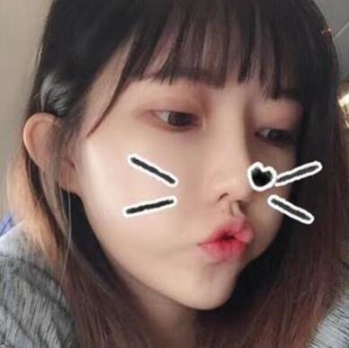 做雙眼皮案例，第四軍醫(yī)大學(xué)唐都醫(yī)院李望舟雙眼皮案例圖片