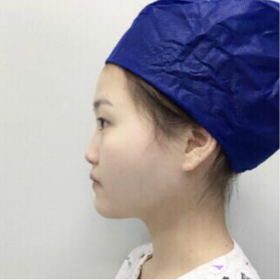 成都美立方（原華博）醫(yī)療美容醫(yī)院王強(qiáng)做肋軟骨隆鼻案例效果分享