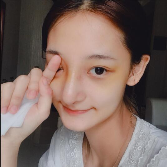 成都蜀尚蓉雅美容整形醫(yī)院做鼻綜合術后的最終恢復情況