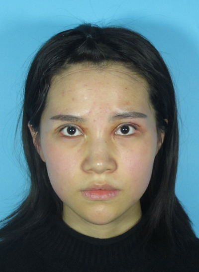 成都美立方（原華博）醫(yī)療美容醫(yī)院張娟眼部修復(fù)案例效果分享